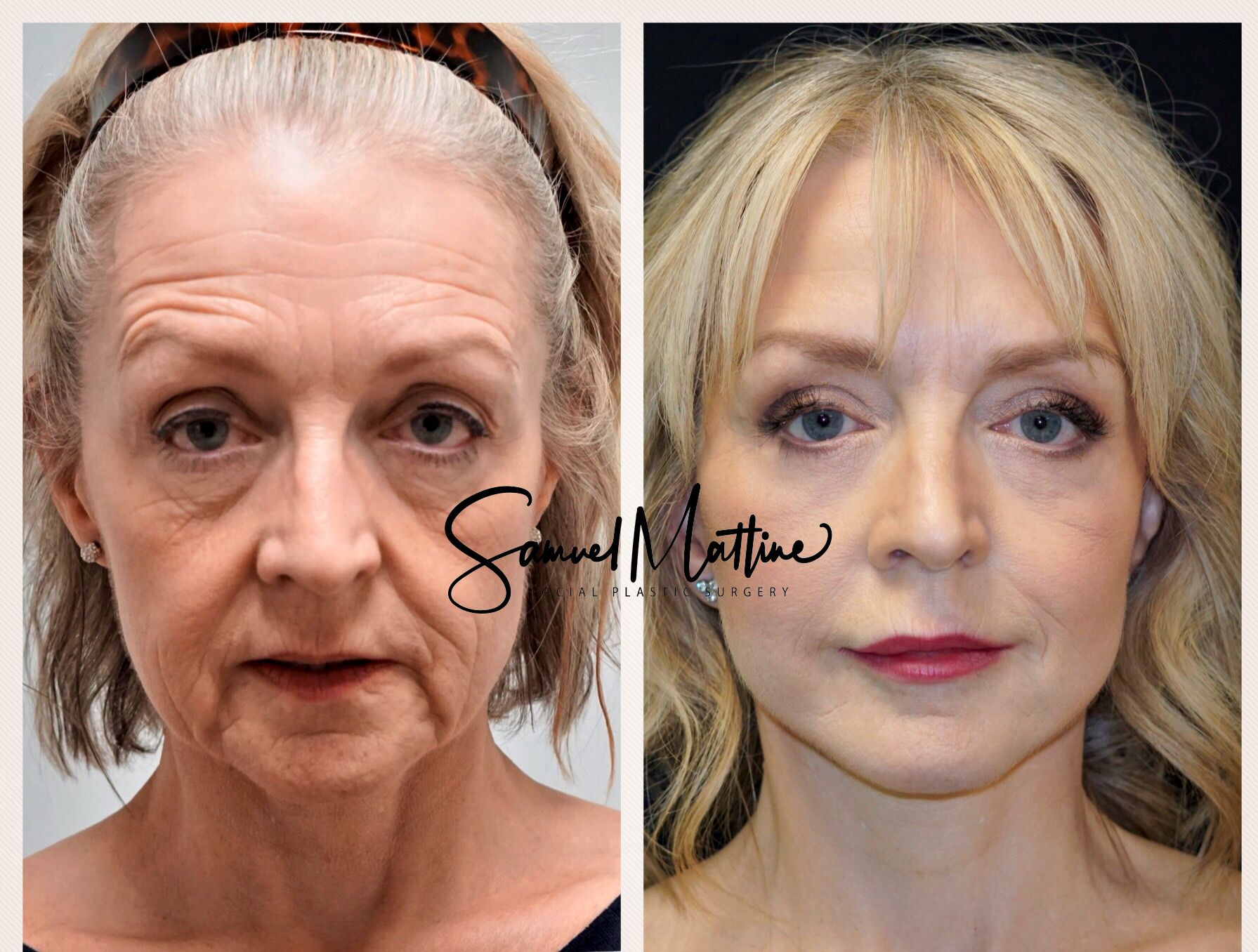 Before and After Face Lift 2