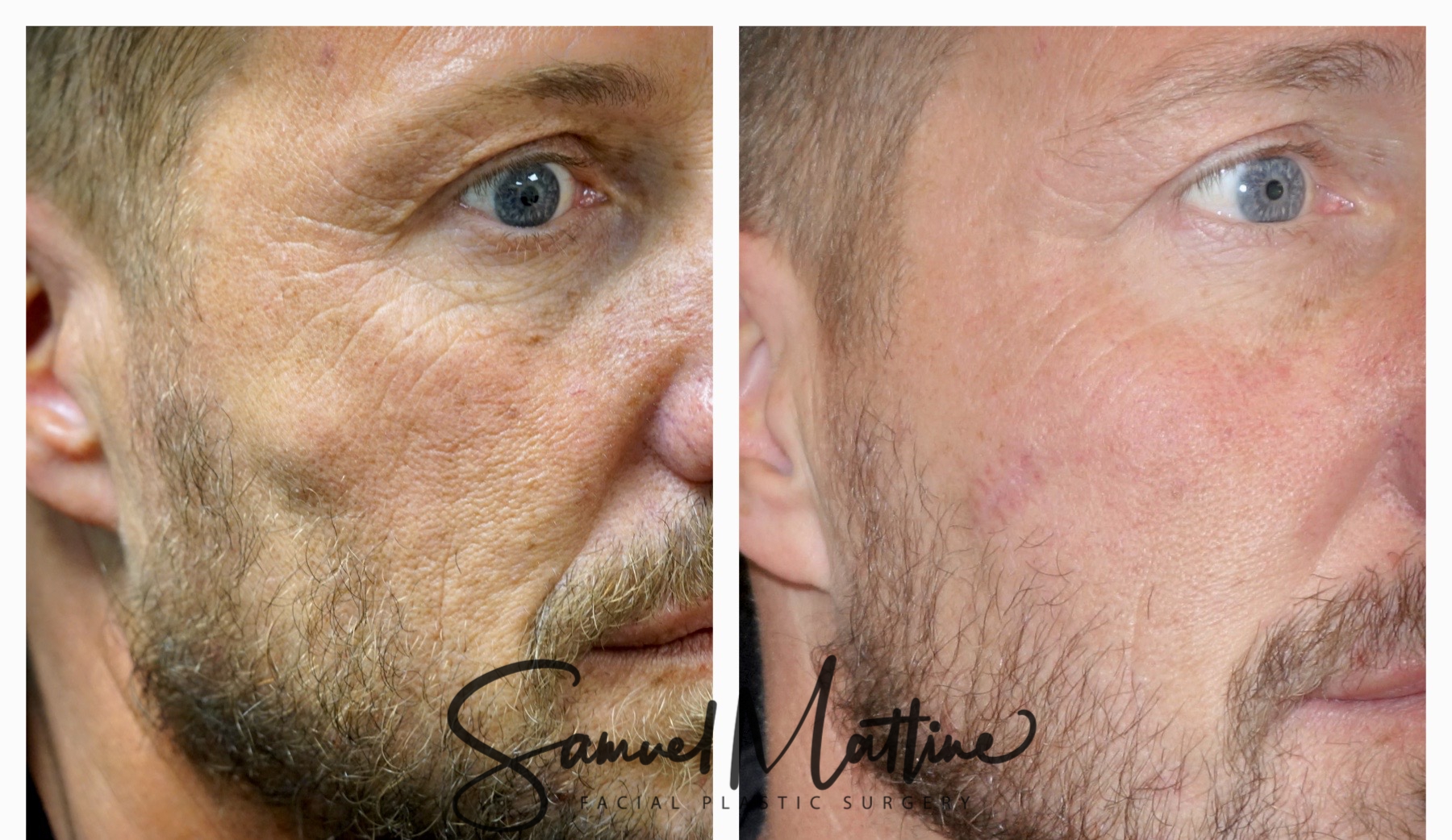 Excision of Deep Facial lump